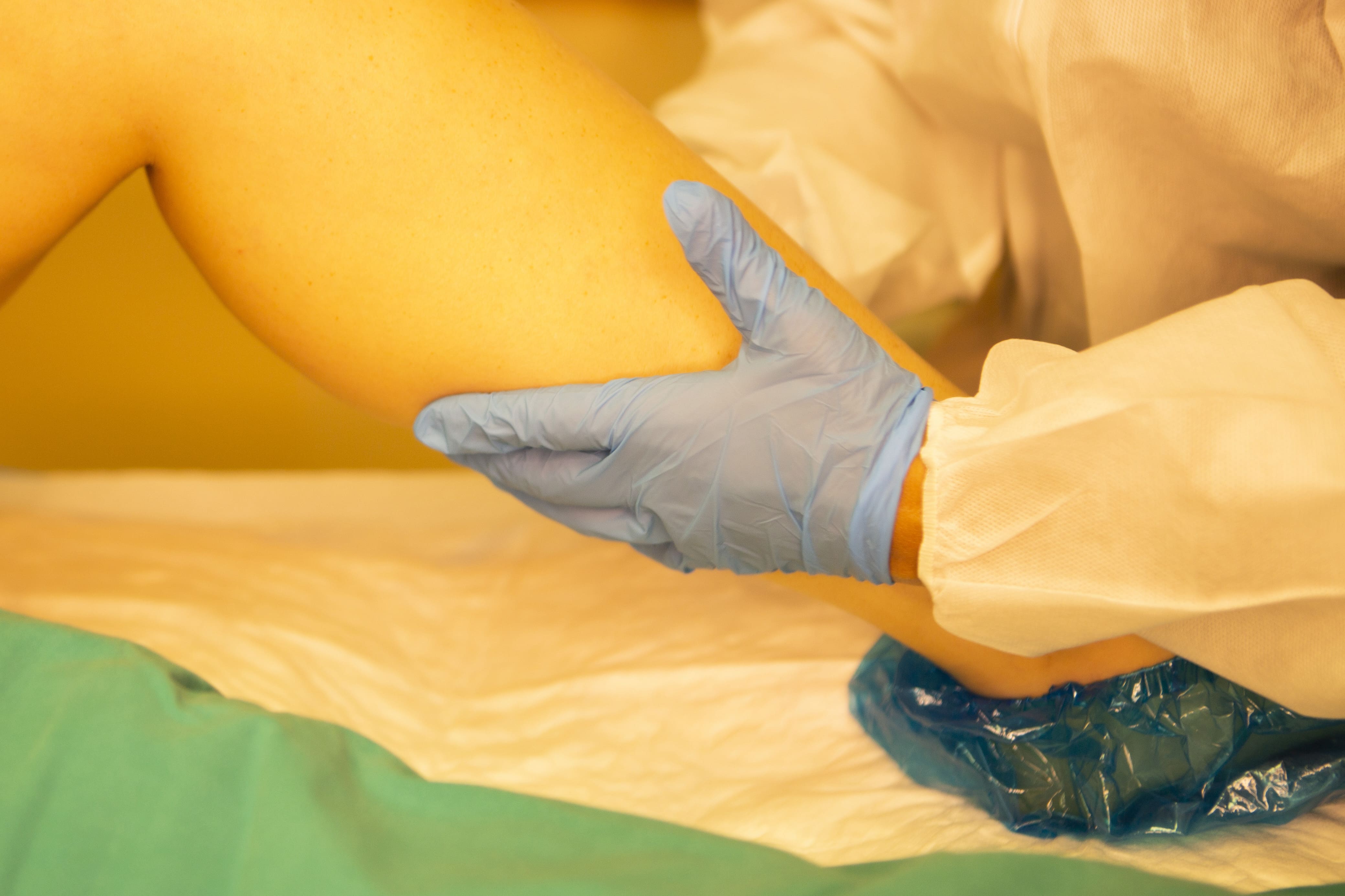 Flebologia Trattamento